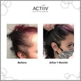 thumbnail image 4 of Remedy Dandruff Shampoo Treatment Remedy by ACTiiV Hair Science, 4 of 5