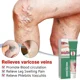 thumbnail image 2 of Tratamiento de venas varicosas eficaz ingrediente Natural alivio de venas varicosas, tratamiento del dolor de araña, Vasculitis flebitis, 2 of 4