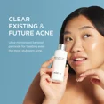 thumbnail image 4 of Jan Marini Skin Research Benzoyl Peroxide Acne Treatment Lotion 10% - 4 Fl Oz, 4 of 9