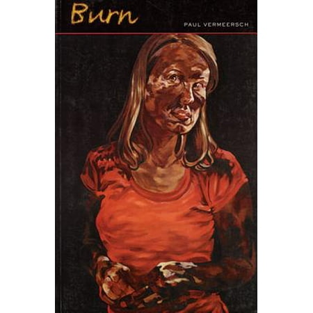 Burn