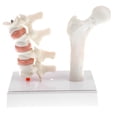 thumbnail image 3 of 1: 1 Modelo de Patología de Osteoporosis de Herramienta de Enseñanza en Laboratorio, 3 of 9