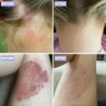 thumbnail image 4 of Grahams Natural Psoriasis Moisturizing Cream for Scalp, Face & Body, Steroid-Free, 2.64 oz Tube, 4 of 7