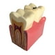 thumbnail image 4 of Modelo De Herramienta De Enseñanza Cariados Dispensión Gingival Modelo 2 DYNWAVEMX Molde de estudio de compactación de caries, 4 of 5