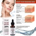 thumbnail image 2 of 30ml Tca D2t1 20% ácido tricloroacético antiarrugas suero para la piel cuidado Facial cuidado de la piel, 2 of 3