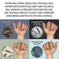 thumbnail image 5 of 2x 30ml Nails Care Repair Nail Fungal Anti-fungus Onychomycosis-removal Liquid Ginger Foot Antifungal Nail Treatments - Hz, 5 of 5