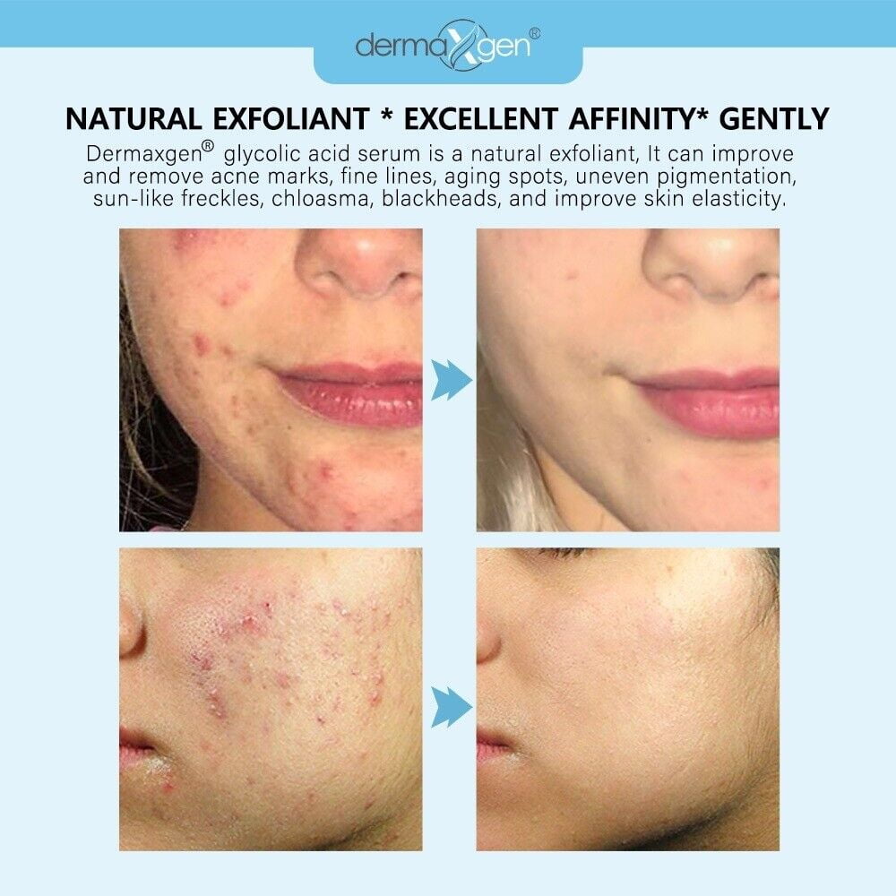 Glycolic Acid Serum PURE 100 ORGANIC Skin RESURFACING Acne Scars Fine Wrinkles, 8 FL OZ