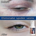 thumbnail image 4 of Ungüento efectivo para aliviar las venas varicosas, crema para aliviar la Vasculitis, flebitis, tratamiento del dolor de araña, 4 of 5