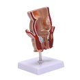 thumbnail image 1 of Modelo de AnatomíA, Modelo de LesióN de Hemorroides Rectales Humanos, FíStula de Hemorroides, , Modelo de EnseñAnza de PatologíA, 1 of 8