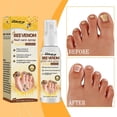 thumbnail image 2 of Bee Venom Nail Treatment Solution, Bee Venom Nail Fungus Treatment, Extra Strength Nail Repair Solution, Nail Fungus Care Spray, 2 of 5