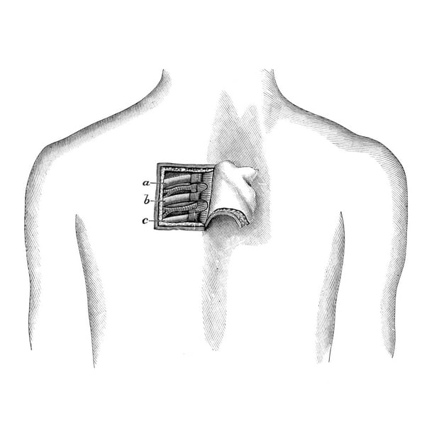 Surgery 19Th Century Noperation Of A Posterior Thoracotomy The Surgical Incision Of The Chest Wall Illustration From A 19Th Century Surgery Text Poster Print by Granger Collection - Walmart.com - Walmart.com Surgery 19Th Century Noperation Of A Posterior Thoracotomy The Surgical Incision Of The Chest Wall Illustration From A 19Th Century Surgery Text Poster Print by Granger Collection - Walmart.com - Walmart.com