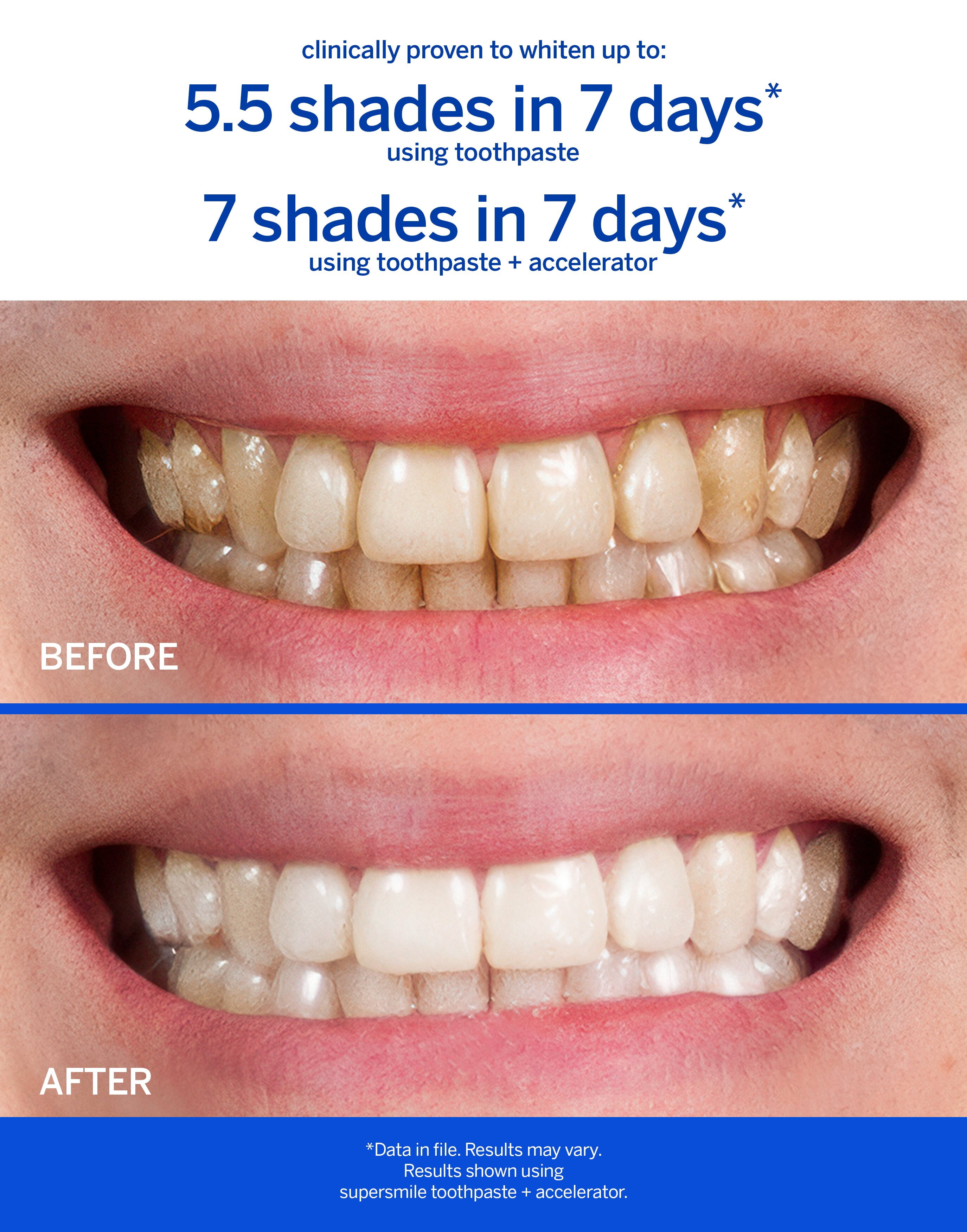 Supersmile Whitening Accelerator - Thumbnail 4