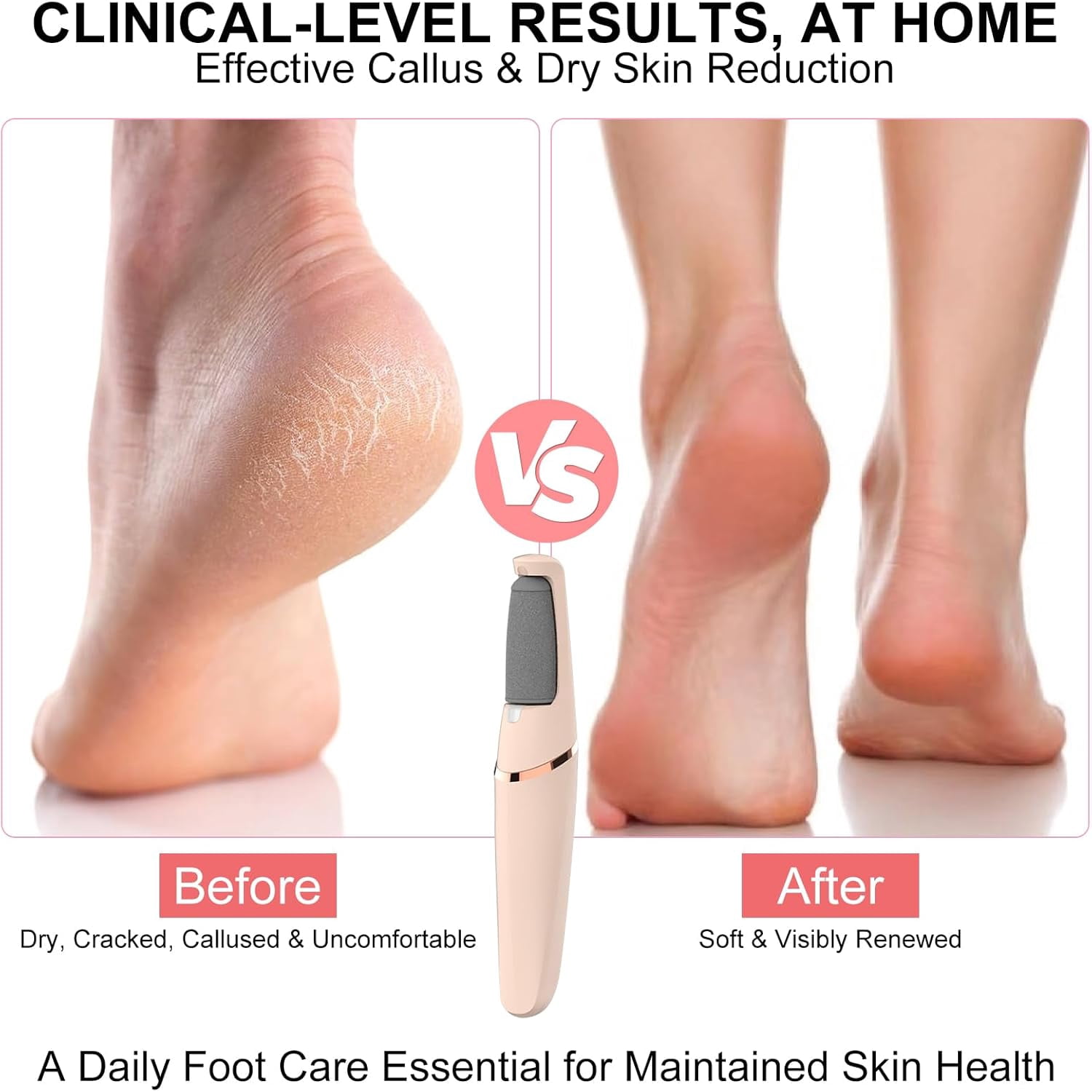 Aorsher Electric Callus Remover with 2 Durable Heads, Rechargeable Professional Cordless Hard Skin Removal for Dry &Dead Cracked Skin, Foot Pedicure Tool for Feet