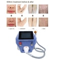 thumbnail image 4 of Hair Removal Machine, Vertical Type 3 Wavelength Hair Removal Skin Rejuvenation Machine Instrument For Whole Body Hair Removal, 4 of 8