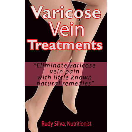 Varicose Vein Treatments - eBook (Best Natural Treatment For Varicose Veins In Legs)