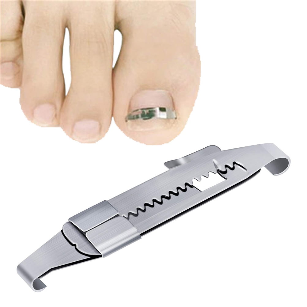 Toenails Correction Ingrown Toenail Correction Wire Fixer Professional