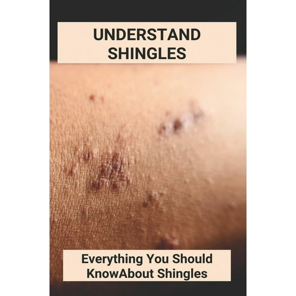 Treatment Shingles