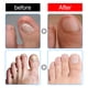 thumbnail image 3 of Parches De Corrección De Uñas Pegatinas de corrección de uñas Corrector de uñas encarnadas Parches Uñas, 3 of 8