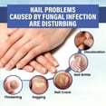 thumbnail image 3 of 2pcs Nail Fungus Laser-device Light Therapy Onychomycosis Toes Treatment Home, 3 of 5