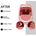 thumbnail image 5 of Professional tonsil stone removal tool for oral care, 5 of 5