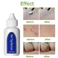 thumbnail image 4 of Agente eliminador de verrugas genitales de 30 ml Líquido para eliminar verrugas Eliminador de lunares, 4 of 5