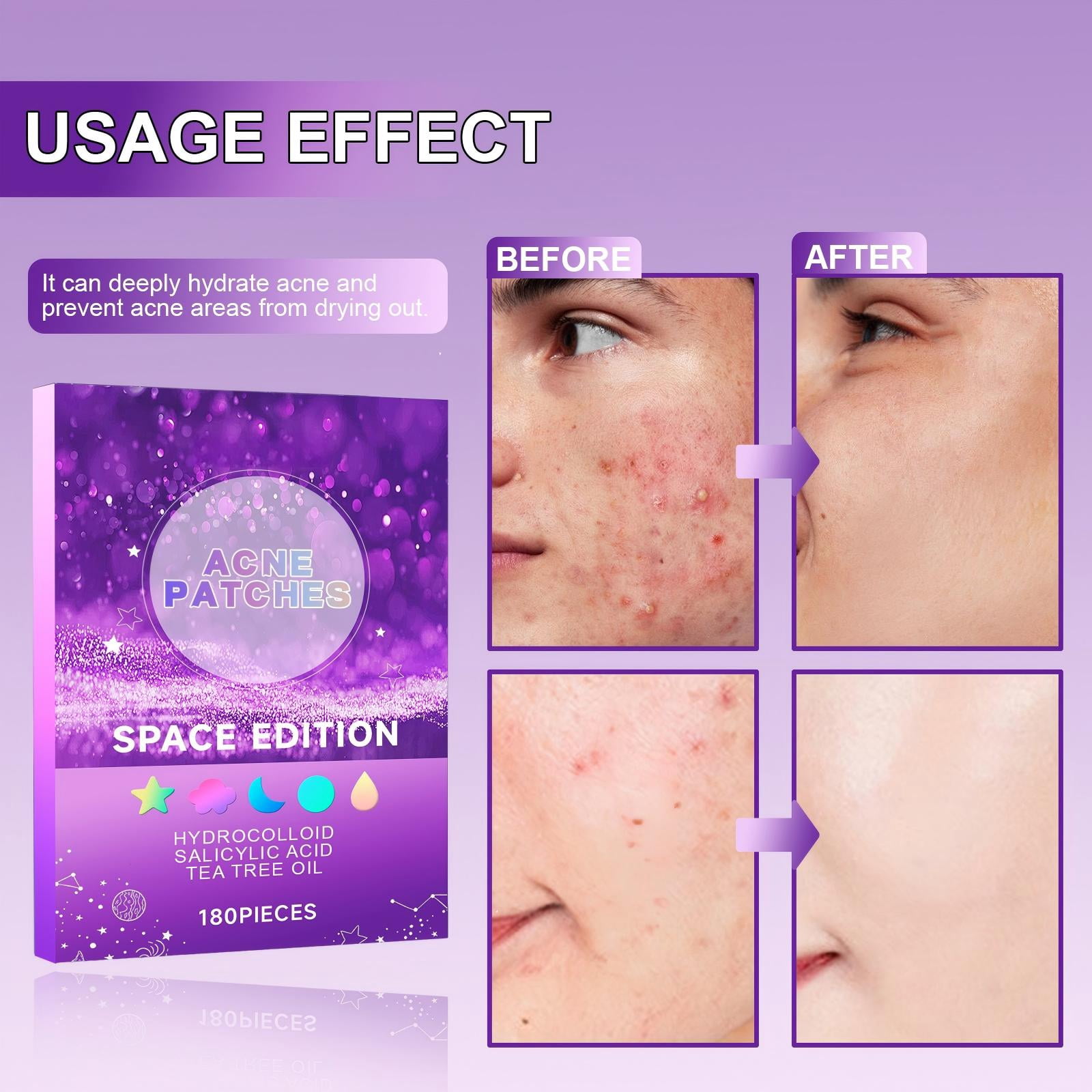 Alvantor Acne Patches Salicylic Acid Pimple Patches for Face Day/Overnight Hydrocolloid Zit Stickers Invisible Spot Treatment, 180pcs