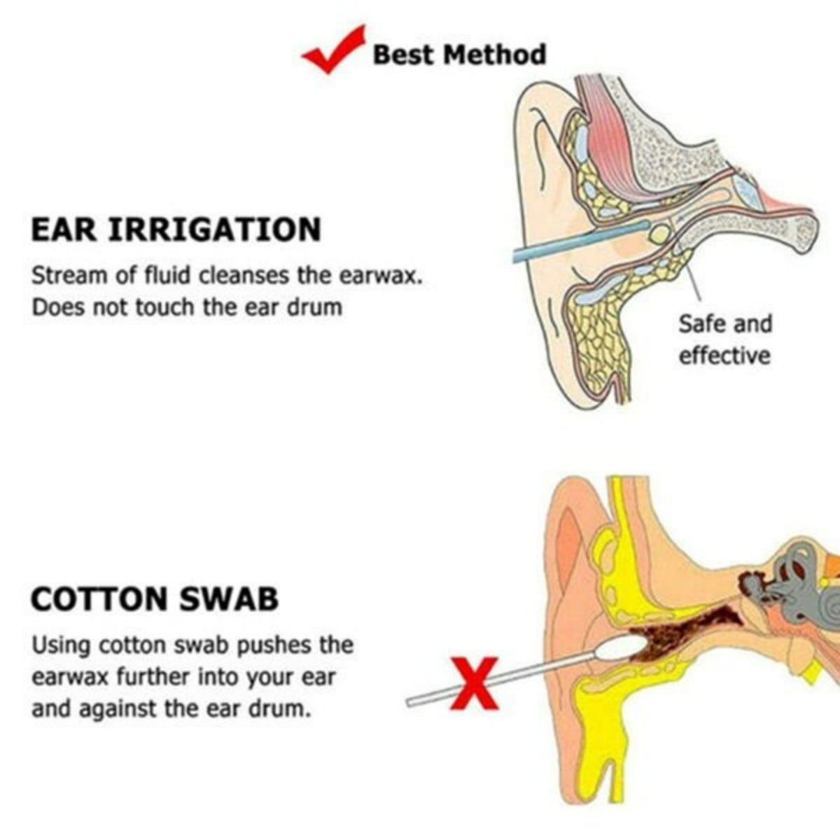 Trick of the Trade: Ear Irrigation in the Emergency Department