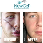 NewGel+ by MyNewGel Silicone Scar Gel with Vitamin E, Reduce & Fade Scars, 1 oz