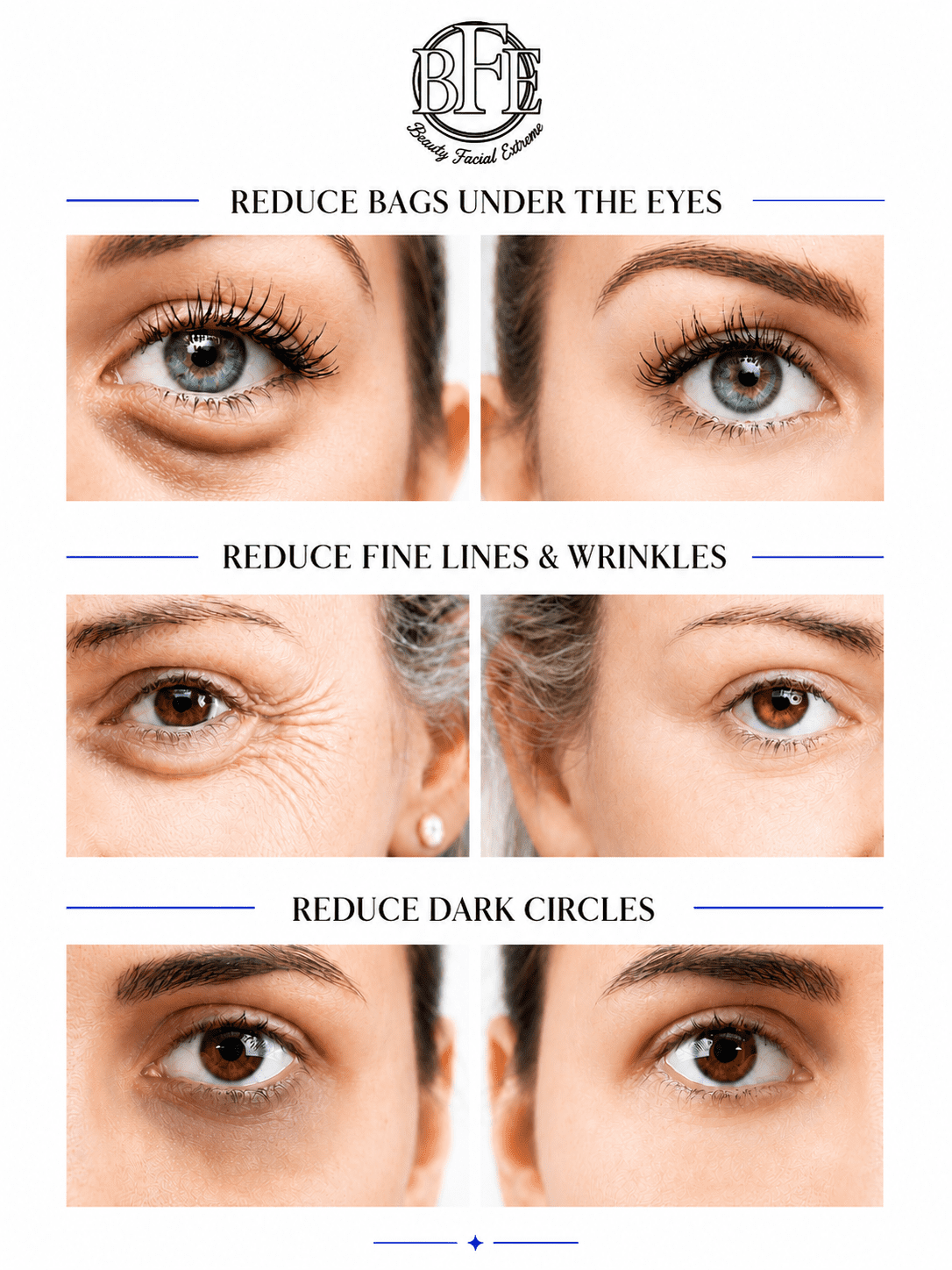 Instant Eye Tightener Cream - Reduces Under Eye Puffiness, Bags, Dark Circles. Lift Technology to Tighten & Firm Sagging Skin Around Eyes. Smooths Away Crow’s Feet, Fine Lines & Wrinkles.