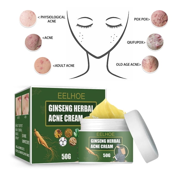 Herbal Acne Cream, Acne Removal, Fading Acne Marks, Moisturizing, Cleansing Cream, Balancing Water and Oil, Acne Cream