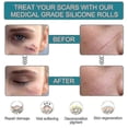 thumbnail image 4 of Silicone Scar Stickers Medical Silicone Easy-tear Gel Tape Roll Medical Grade, 4 of 5