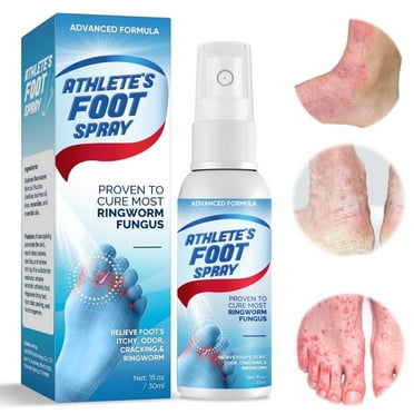 Athletes Foot Spray, Athletes Foot Treatment, Anti-Fungi Treatment for Feet Itchy, Feet Treatment with Natural Ingredients, 30ML