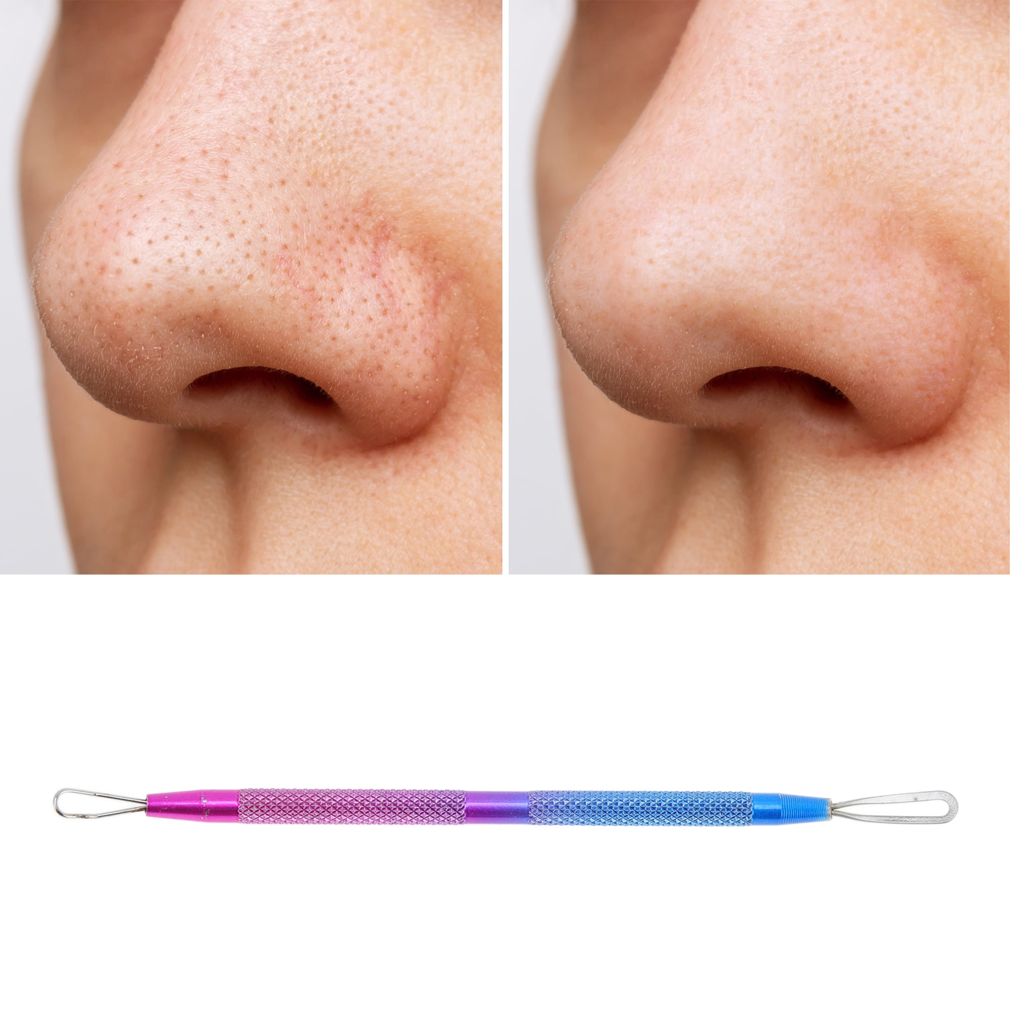 Unique Bargains 1pc Durable Squeeze Pimple Extractor Tool for Clear Skin Blue Purple