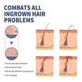 thumbnail image 3 of Razor Bumps Treatment for Men, After Shave Solution Roll-On for Ingrown Hairs and Razor Burns, Razor Bumps Solution, 3 of 5