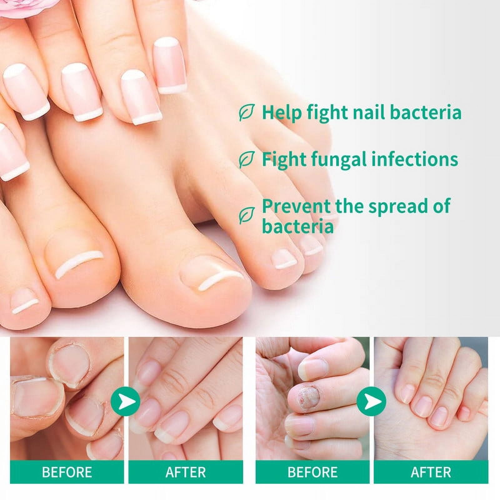 Kerassentials Toenail Treatment Oil, Kerasentials Toenail Nail Treatment for Damaged and Discolored Nails, Nail Treatment Drop For Fungal Infections(3 pcs)