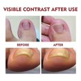 thumbnail image 3 of 2 uds. Aceite para aliviar la paroniquia de los pies, aceite para el tratamiento de la corrección de las uñas de los pies, ayuda para el crecimiento de las uñas, 10ml, 3 of 5