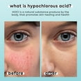 thumbnail image 2 of Spray de ácido hipocloroso LivaClean para rostro y cuerpo 60 ml, 2 of 8
