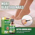 thumbnail image 1 of Tratamiento de hongos en las uñas de los pies con aceite de árbol de té, 1 of 5