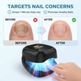 thumbnail image 5 of Nail Fungus Laser LED Light Device – Relieves Thick/Discolored Nails, Deformation & Pain (Black, Rechargeable), 5 of 6