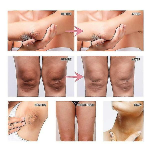 Las Axilas Como Evitar Granitos Despues De Depilarse Blanquear