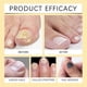 thumbnail image 5 of Bee Venom Fungal Nail Treatment For Toenail Extra Strong, Nail Fungus Solution, Anti Toe Toenail Nail Fungal Solution For Ingrown Toenail Treatment, 5 of 5