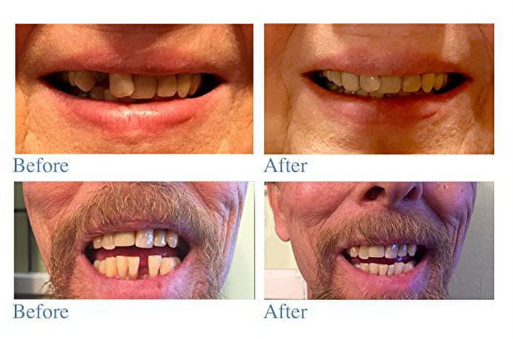 Instant Smile Temporary Tooth DELUXE 3 SHADES of Temporary Teeth Included