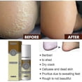 thumbnail image 3 of Fungal Combat Feet Spray Foot Sterilize Spray Anti-fungal Infection Toe Treatment Onychomycosis Anti Ba, 3 of 4