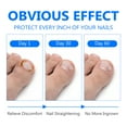 thumbnail image 3 of Ingrown Toenail Treatment, Toenail Fungus Treatment Extra Strength, Ingrown Toenail Removal Kit, 3 of 9