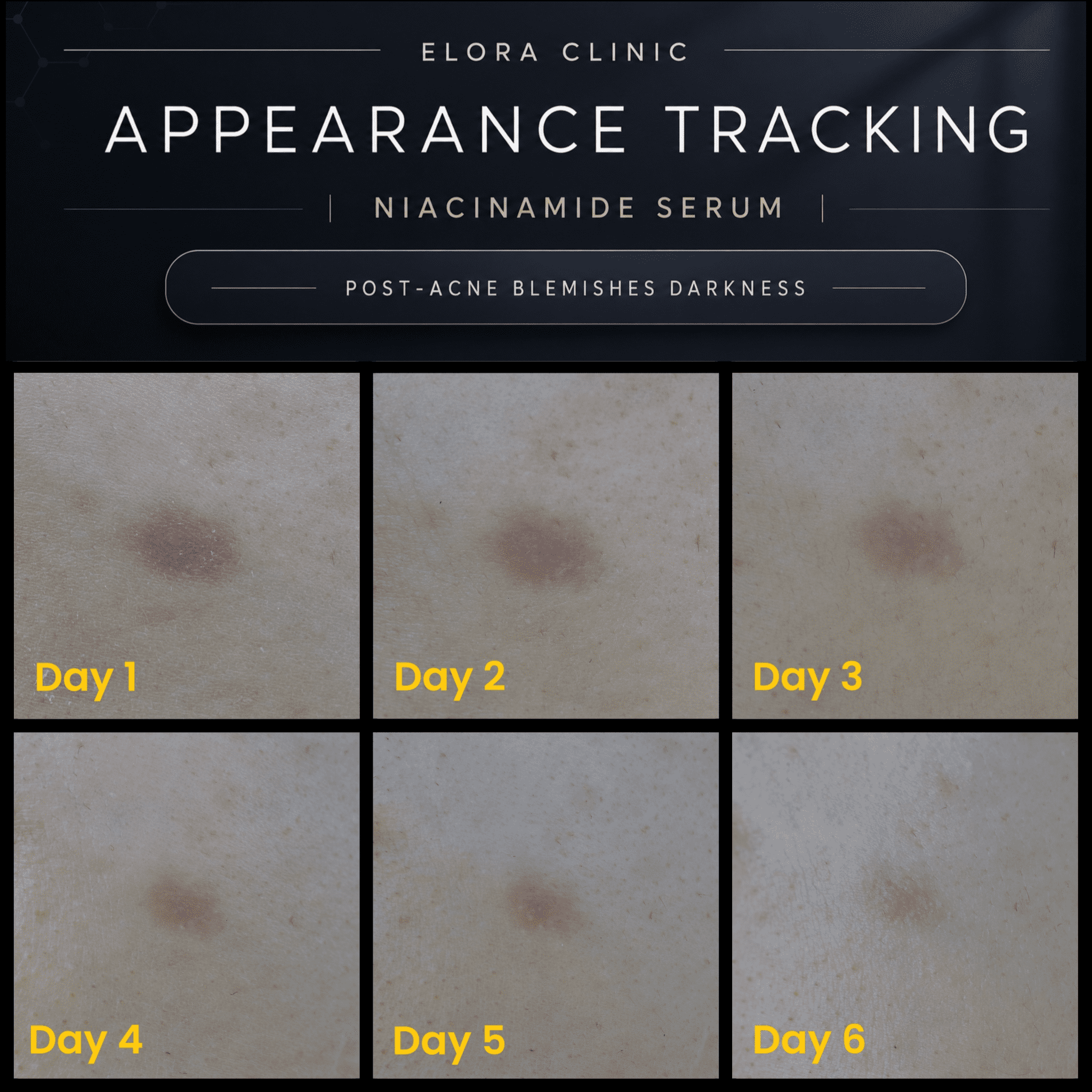 Elora Clinic  Niacinamide Serum - Hyaluronic Acid serum With Niacinamide - Niacinamide For Dark Spots -Lightweight Water Based Hyaluronic Acid With Niacinamide Serum