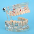 thumbnail image 1 of Modelo Patológico De Dientes Para Adultos, Modelo De Implante Dental, Modelo De Enseñanza De Dientes Para Estudio Dental, 1 of 7