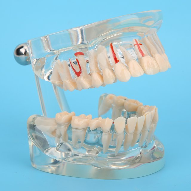 Modelo Patológico De Dientes Para Adultos, Modelo De Implante Dental, Modelo De Enseñanza De Dientes Para Estudio Dental