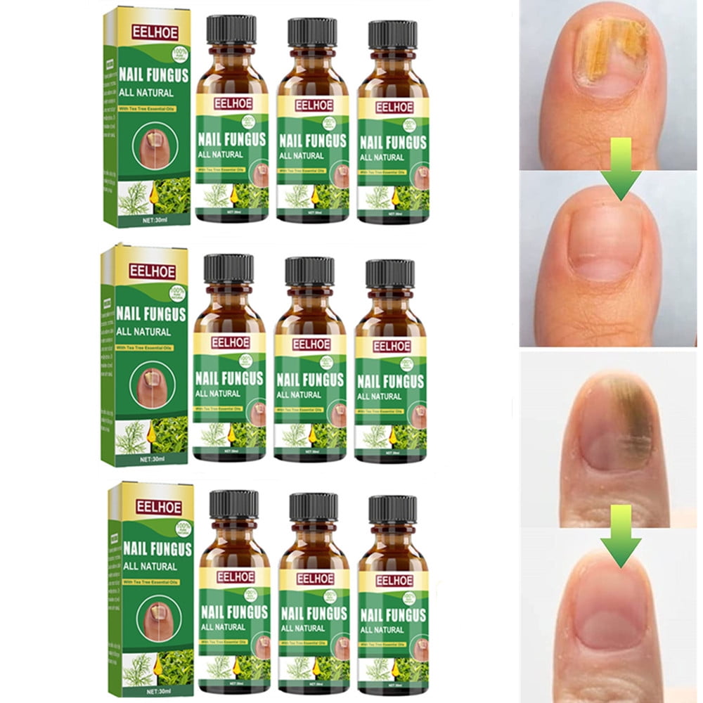 Toenail Fungus Treatment, Effective Nail Fungus Treatment for Toenail