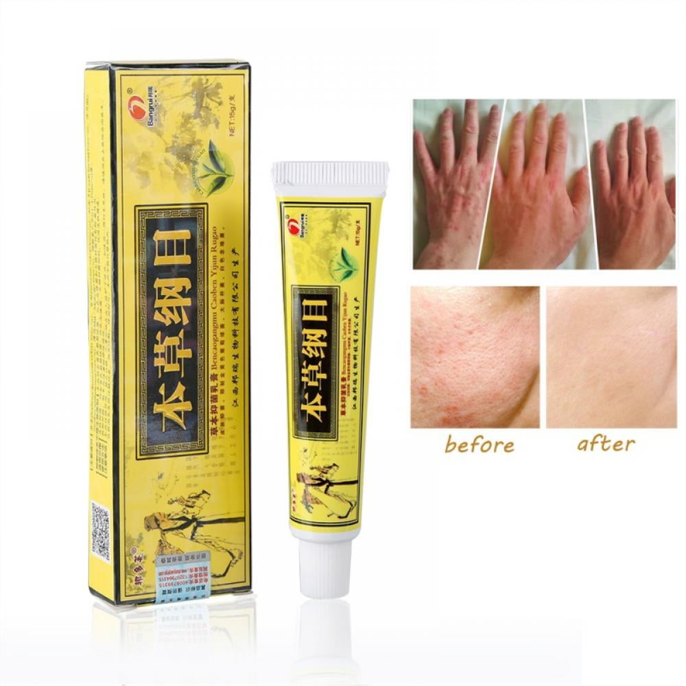 Natural Chinese Herbal Cream Eczema,Psoriasis Creams Dermatitis and ...