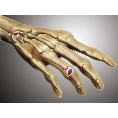 Conceptual image of rheumatoid arthritis in the human hand RA is a chronic inflammatory disorder that typically affects the small joints in your hands and feet Poster