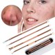 thumbnail image 2 of Piezas Blackhead Remover Acne Pimple Remover Tool Acne Kit - Tratar imperfecciones, puntos blancos, eliminar espinillas para una piel facial nasal sin riesgos Ormromra XYWJ165-1, 2 of 7